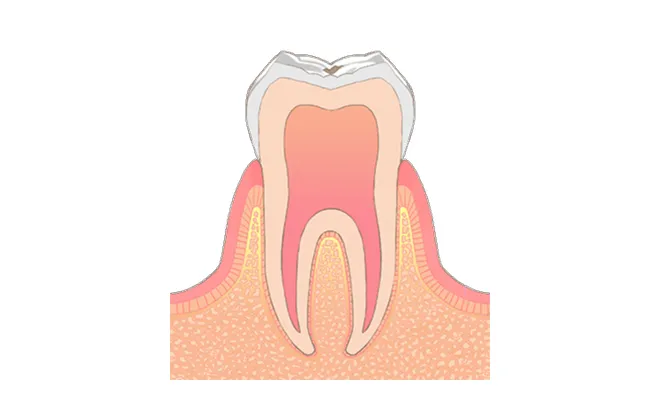 C0 むし歯の前兆