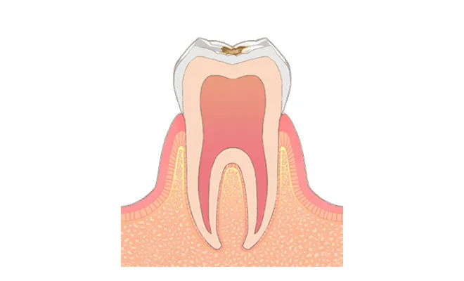 C1 初期のむし歯