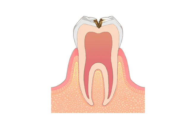 C2 本格的に進行し始めたむし歯