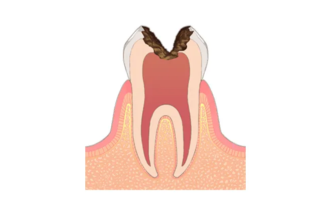 C3 神経まで進行したむし歯
