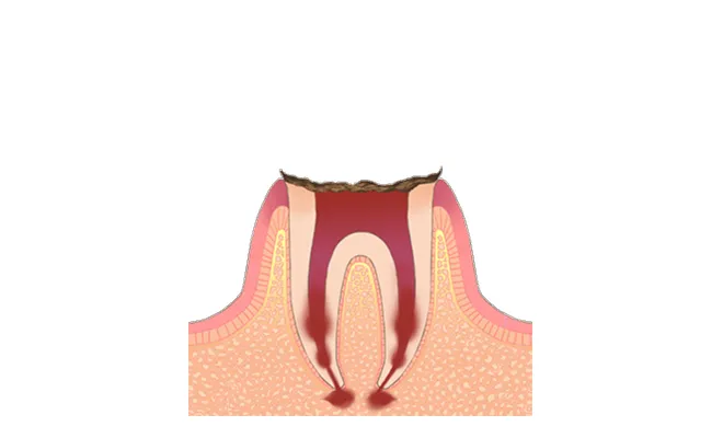C4 ほとんど歯がないむし歯