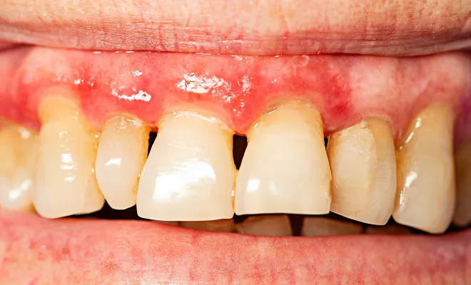 イメージ:歯周病とは