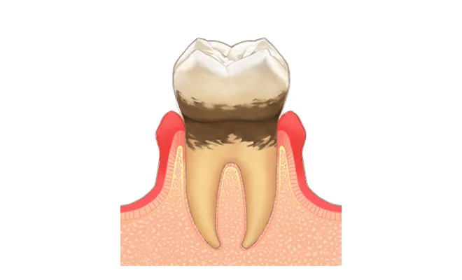 軽度歯周炎