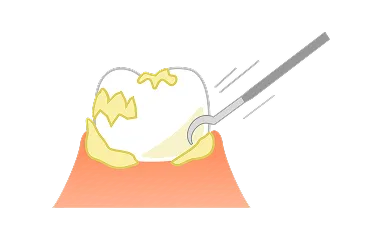 スケーリング&ルートプレーニング