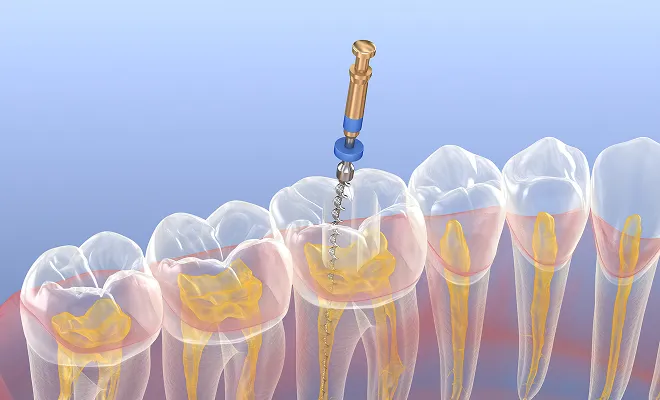 イメージ:根管治療とは